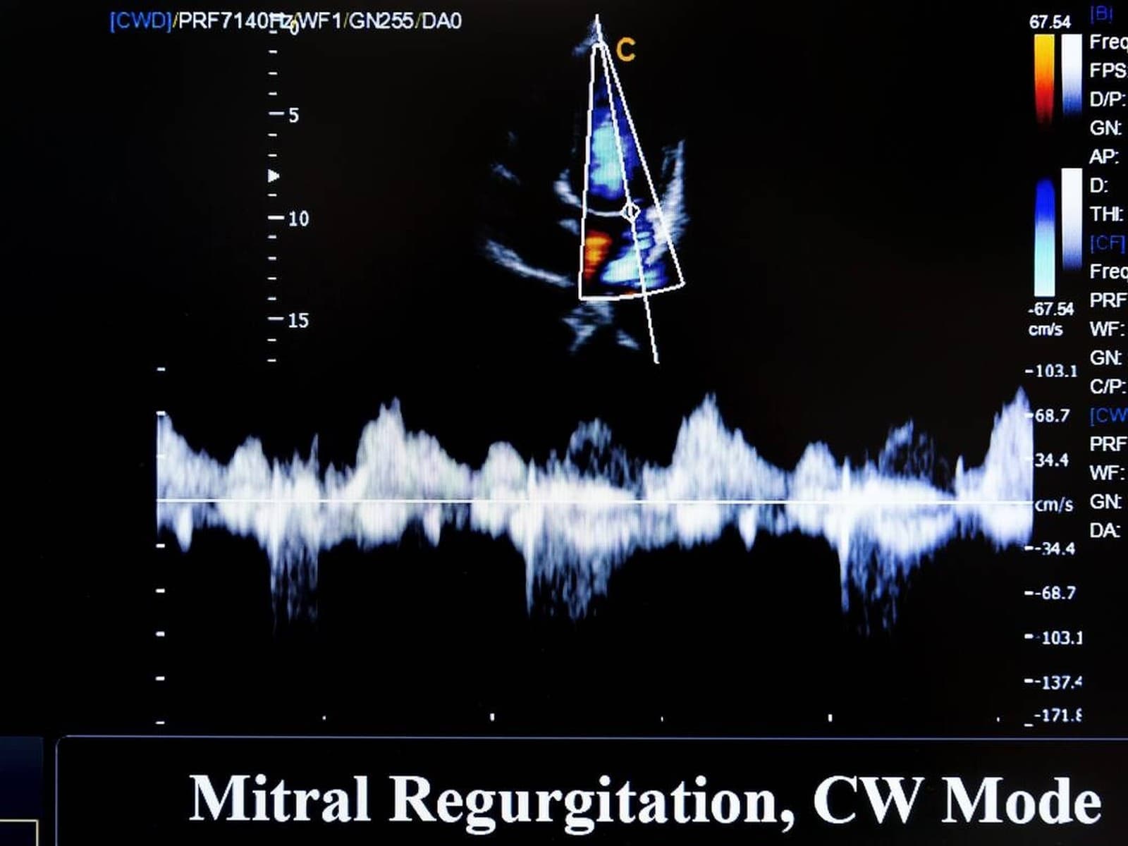 Echocardiogram (heart ultrasound) displayed on a cardiac ultrasound machine